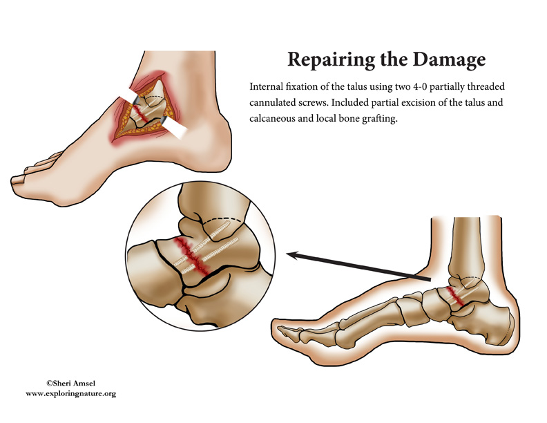 Ankle Surgery