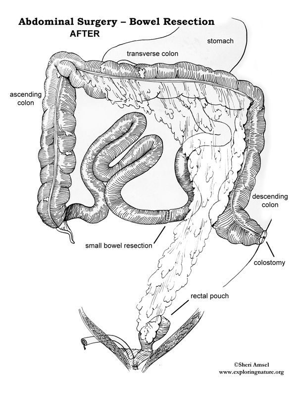 Abdominal Surgery - Bowel Resection