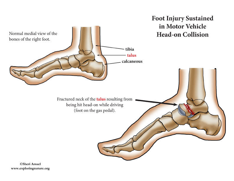 Ankle Injury (Talar Fracture) - Car Accident