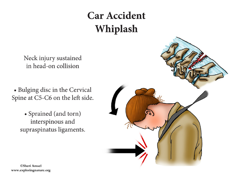 Whiplash