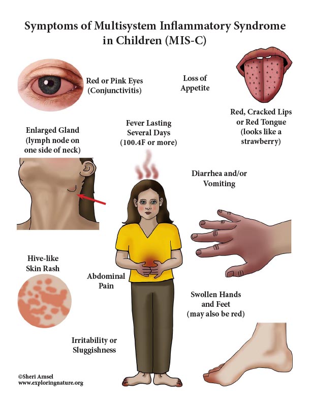 Multisystem Inflammatory Syndrome in Children (MIS-C) Symptoms - Mini-Poster